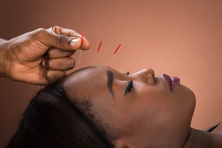 profile head shot of young black woman lying on her back with acupuncture needles being…